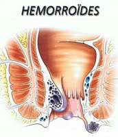 HEMORROIDES  Dr. Axel Ricci
